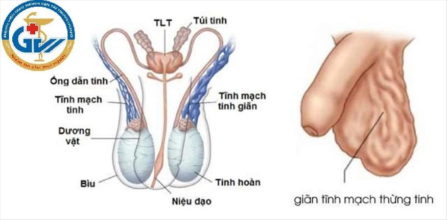 Phẫu thuật giãn tĩnh mạch thừng tinh có rủi ro và tác động phụ nào không?
