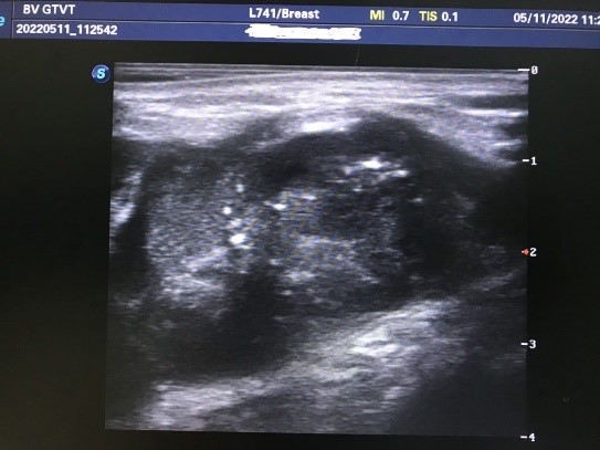 Ung thư vú ở phụ nữ cho con bú