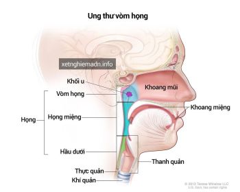 DẤU HIỆU PHÁT HIỆN SỚM UNG THƯ VÒM MŨI HỌNG