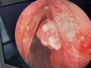 Khoa Tai Mũi Họng Bệnh viện Giao thông vận tải phẫu thuật thành công bệnh nhân có u dây thanh