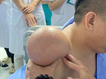 BỆNH VIỆN GIAO THÔNG VẬN TẢI PHẪU THUẬT THÀNH CÔNG KHỐI U  VÙNG VAI NẶNG 1,5 KG